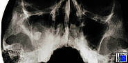 Keratozyste im Unterkiefer mit verdrängtem 48 und follikuläre Zyste im Oberkiefer- und Kieferhöhlenbereich