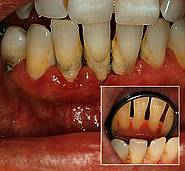 Chronische Parodontitis vor und nach der Behandlung
