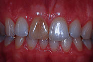 Verfärbter devitaler Zahn 11 nach Trauma