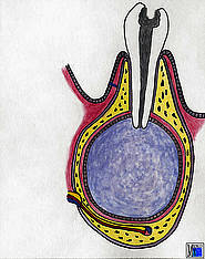 Radikuläre Zyste an einem unteren Prämolaren. Aus Krüger: Farbatlas der dentoalveolären Chirurgie, Hüthig (1997)