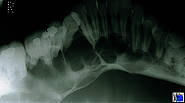 Große gekammerte Zyste des Unterkiefers bei vitalen Zähnen. Therapie: Zystostomie