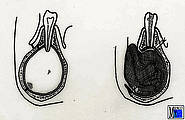 Schematische Darstellung der Zystostomie im Unterkiefer