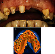 A – präparierte Zähne 13-12-11-23; 4 C – Korrekturabformung