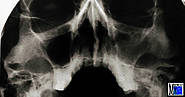Sinusitis der linken Kieferhöhle, ausgehend von 26