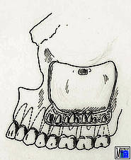 Sagittalschnitt durch die Kieferhöhle mit Darstellung der Zahnwurzeln