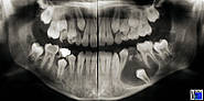 Follikuläre Zysten der verlagerten Zähne 45 und 35 mit Milchzahnpersistenz