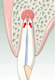 Zahn mit apikaler Entzündung
