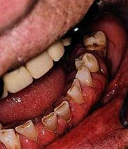 Gingivahyperplasie bei Einnahme bestimmter Medikamente