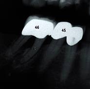 Zahn 46 – mesiale Wurzel mit apikaler Entzündung