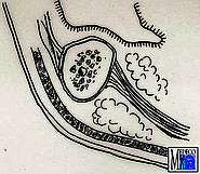 Alveolarkammatrophie des Unterkiefers