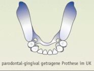 Parodontal-gingival getragene Prothesen