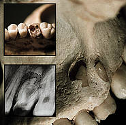 Auswirkungen der apikalen Parodontitis im Knochen