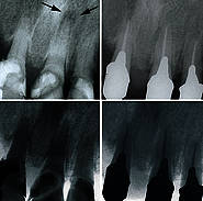 Zahn 21 mit apikaler Entzündung als Karies- und Pulpitisfolge