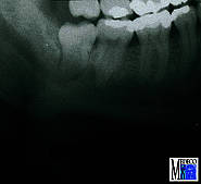 Verlagerter Zahn 48