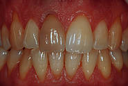 Verfärbter devitaler Zahn 11