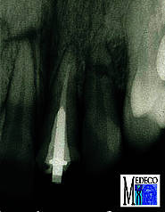 Wurzelfraktur Zahn 22