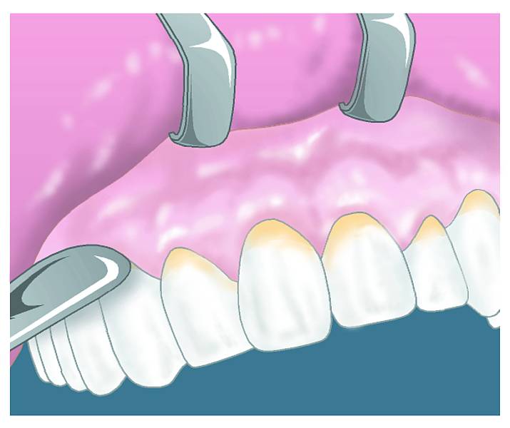 gingival curettage