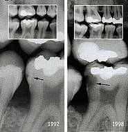Zahnklinik MEDECO Hamburg: Kariesdiagnostik