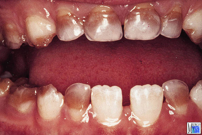 Verfärbungen der Zähne.