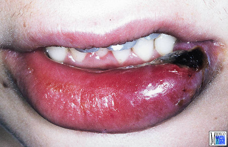 lippen kauen