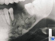 Zahn ziehen nach kieferknochenentzündung Kieferentzündung