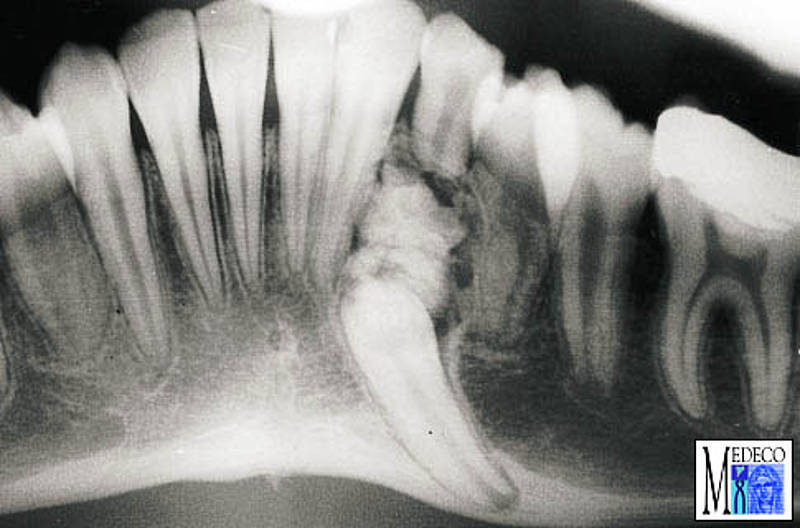 Odontogene Tumoren