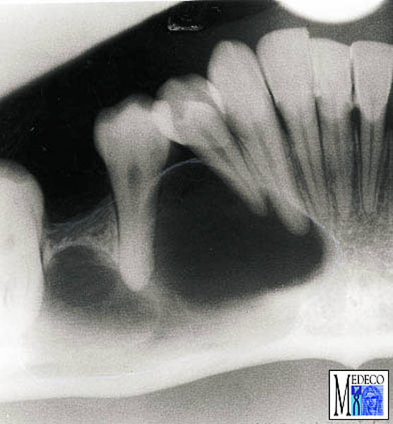 Odontogene Zysten
