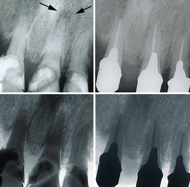 Diagnose und Einteilung von Pulpaerkrankungen