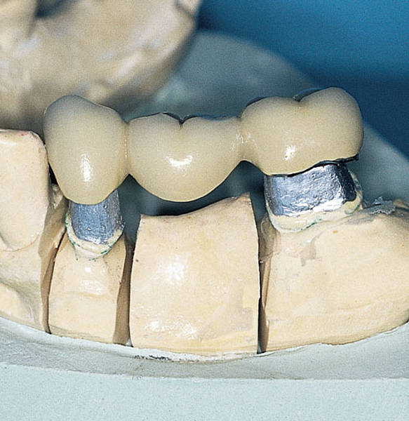 Bloccare Dente Che Si Muove Ponti