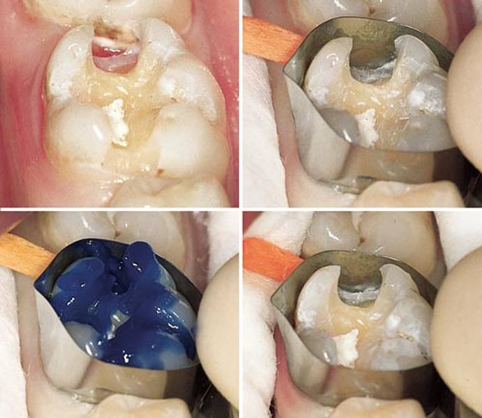 Cavity Filling Process
