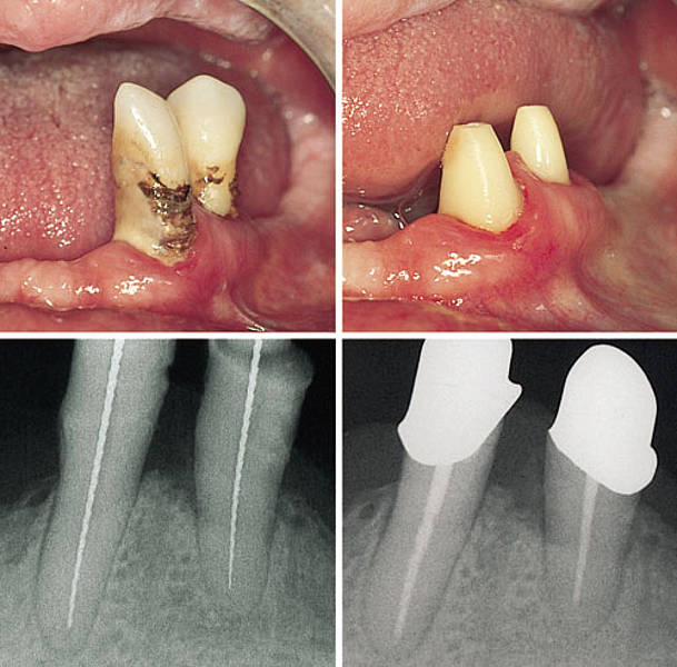 Pulpa hiperemia