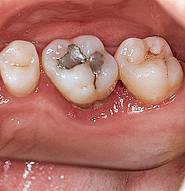 Aggressive Parodontitis am Zahn 26