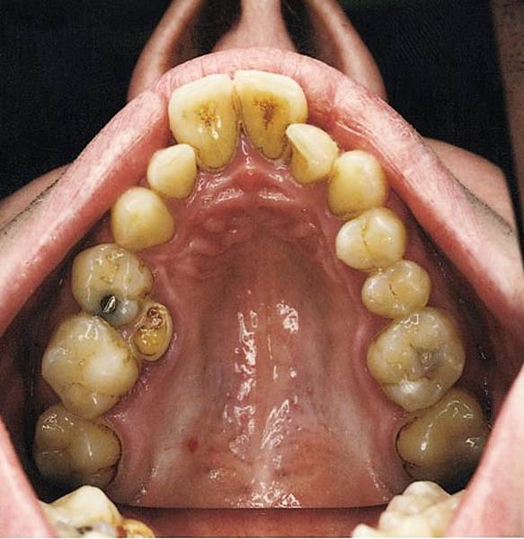Narrow jaw