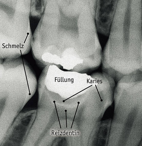 Ursachen von Pulpaerkrankungen