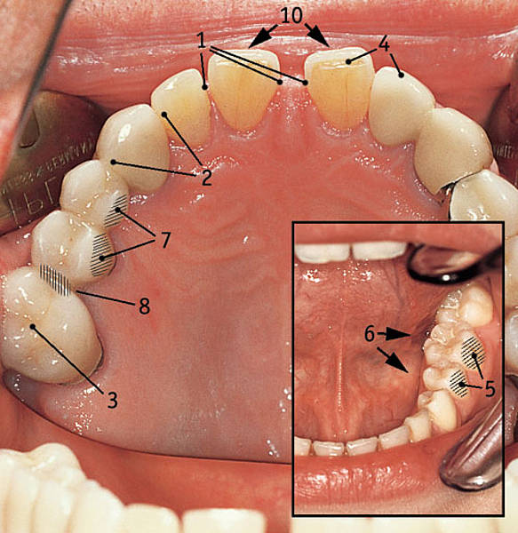 Dental surface description