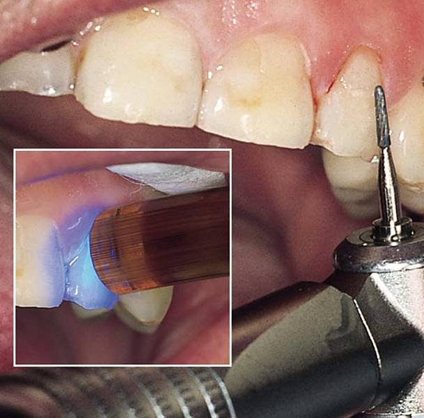 Terapia di otturazione in presenza di danni dentali