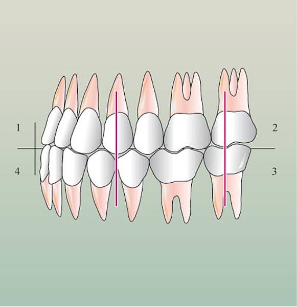 Distal occlusion