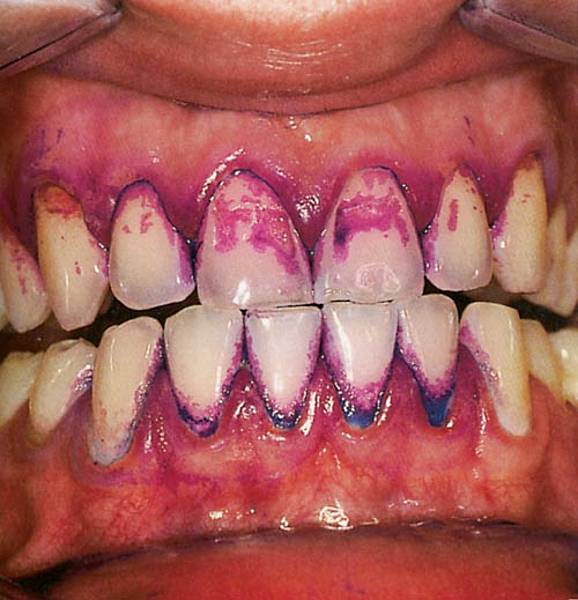 Biofilms/plaque dentai...