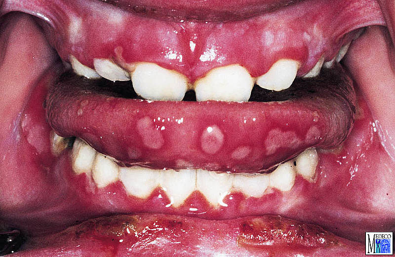 Non-plaque induced diseases
