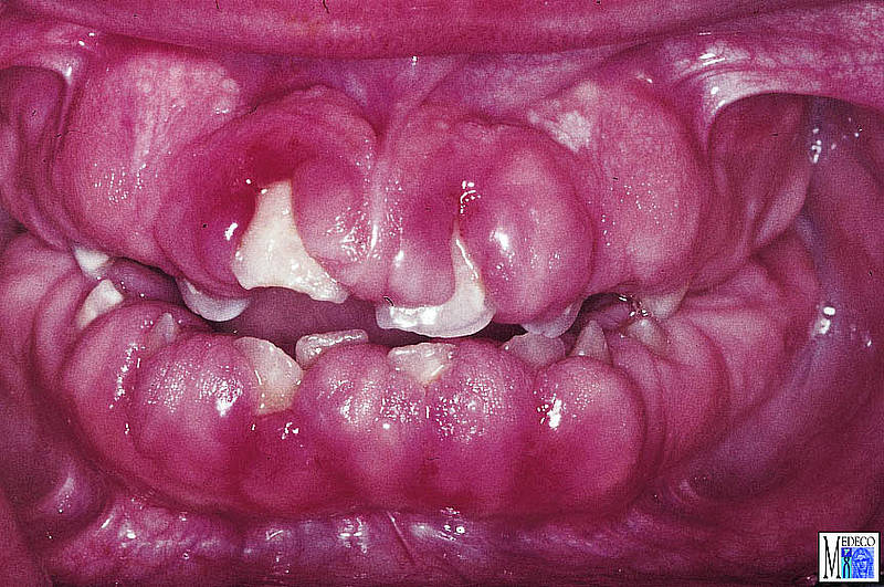 Plaque induced diseases Plaque induced diseases