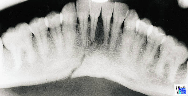 Alveolar process fracture
